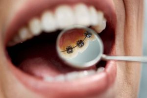 Fixed Retainers