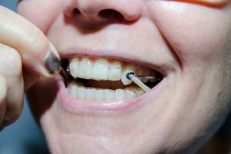 Braces Removal